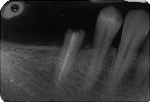 Figure 1 Preoperative periapical radiography, inappropriate root canal treatment of 4.5 and a periapical lesion.