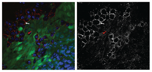 Figure 2 Eiger/dTNF is primarily expressed by tumor-associated hemocytes. The confocal image displays a RasV12/scrib imaginal disc tumor. The tumor cells are labelled with GFP (green), Eiger immunostaining is in red and nuclei are shown in blue. The Eiger staining is shown in grey in the lower part. The white arrow points to a tumor-associated cell that expresses high levels of Eiger. These tumor-associated cells were identified as plasmatocytes, a sub-type of haemocytes.Citation23 The red arrow points to a tumor cell displaying Eiger staining in the form of intracellular puncta, identified previously as endocytic compartments.Citation22