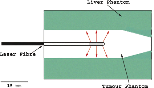 Figure 1. Schematic showing the laser position inside the phantom. The tumour is seen as the central region surrounding the laser. The grey area at the end of the laser shows the diffusive tip, the active, light-emitting region of the laser.