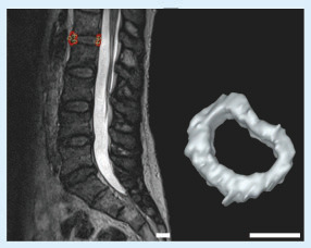 Figure 3. The segmentation process.Left: L1–L2 intervertebral disc of the patient. Right: the 3D model of the intervertebral disc after completing the segmentation (scale bars: 2 cm).