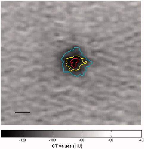 Figure 8. Illustration of overlay damage level of the fat tissue on top of the CT image. The indentation depth index was calculated for each pixel around the focal zone of a CT image, obtained immediately after HIFU treatment termination, regardless of the temperature data. The results were analysed and transformed into three levels, as assessed by the indentation depth index values, marked by three contours. Each contour represents an area with a different level of tissue damage, where the most inner contour (red) indicates higher estimated damage level. The black bar is 5 mm.