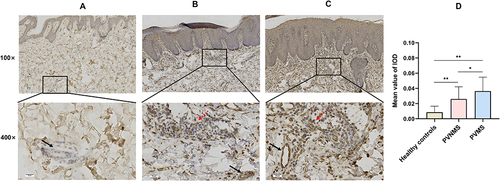 Figure 2 Expression of interleukin (IL)-9 in psoriasis vulgaris and normal human skin. IL-9 staining rarely occurred in normal dermis ((A), n = 7), whereas scattered and strong expression was observed in inflammatory cells (red arrow) and vascular endothelial cells (black arrow) in the skin of psoriasis vulgaris patients without metabolic syndrome (PVNMS) ((B), n = 30) or psoriasis vulgaris patients with metabolic syndrome (PVMS) ((C), n = 30), respectively (Scale bar, 50 μm). The expression levels were quantitatively analyzed by Image-pro Plus (D). IOD, integrated optical density. Data are expressed as the mean ± SD. *P < 0.05, **P < 0.01.