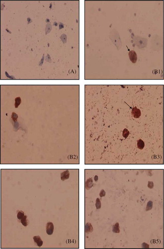 Figure 1. The comparison of the number of urinary podocytes (10 × 20). (A) Control group. (B) IgAN patient group. [(B1–B5) represent the comparison of the number of podocytes in Lee’s I–V groups in IgAN]. Arrows indicate the representative podocytes.