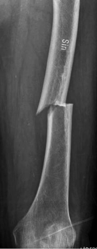 Typical stress fracture in one of the bisphosphonate-treated patients. Note the transverse fracture line on the lateral side and the cortical thickening.