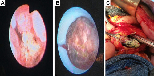Figure 4 (A) Ureteroscopy and pneumatic lithotripsy of a distal ureteric stone. (B) PCNL being performed; a renal stone concealed in an Amplatz sheath. (C) Pyelolithotomy with extraction of a staghorn calculus.