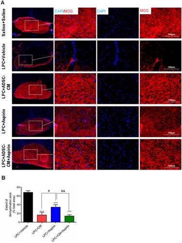 Figure 4 Effect of ADSCs-CM and aspirin on extent of demyelination areas. (A) Immunostaining against MOG as mature myelin marker on day 14 post insult. DAPI: nuclei stain, scale bar: 100 µm. (B) Quantification of MOG staining showed that administration of ADSCs-CM, aspirin or ADSCs-CM + aspirin alleviated the level of demyelination. One-way ANOVA followed by Tukey post-test were used for statistical analysis. ***P<0.001 compared to the LPC + vehicle; #P<0.05 compared to the LPC + ADSCs-CM and &&P<0.01 compared to the LPC + aspirin. n=3.