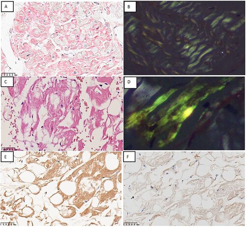 Figure 1. Pathologic evaluation of myocardial biopsy specimen and abdominal fat pad biopsy specimen A. Congo red staining showing focal amyloid deposition in interstitium of myocardial biopsy specimen(×400). B. Amyloid deposition in myocardial biopsy specimen exhibits apple-green birefringence under polarised light microscopy(×400).C. Congo red staining showing focal amyloid deposition in interstitium of abdominal fat pad biopsy specimen(×400). D. Amyloid deposition exhibits apple-green birefringence under polarised light microscopy(×200). E, F. IHC staining showing positivity for kappa light chain and negativity for lambda light chain(×400).