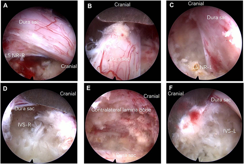 Figure 5 360° decompression of dural sac and nerve roots. (A) Ipsilateral and (C) contralateral decompression of L5 nerve roots and dural sac. (B) Dorsal decompression of dural sac and (E) clear exposure of contralateral lamina bone. Intervertebral space was exposed clearly from (D) ipsilateral and (F) contralateral side after bilateral discectomy.