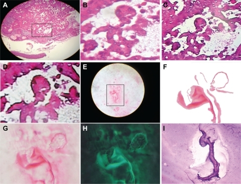 Figure 4 Well-defined self-assembled embryoid body pattern formation. A–D are closeup images of a well-defined embryoid body pattern formation in a case of squamous cell carcinoma of the skin, hematoxylin and eosin staining (20×); E–G show a well-defined, self-assembled embryoid body pattern formation in a case of peritoneal carcinoma with ascites, Papanicolaou staining (20×); H is a negative image of G; I reveals embryoid body self-assembly with geometric triangular chiral hexagonal crystal as a template platform in a case of peritoneal carcinoma with ascites and Papanicolaou staining (20×).