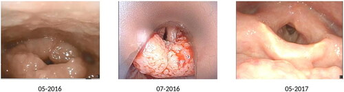 Figure 2. images of patient nr 2. First image is of the larynx at time of presentation. Second image the difficult exposure of the larynx during attempted surgery. Third picture of the larynx a year after presentation and 6 months after last bevacizumab treatment.