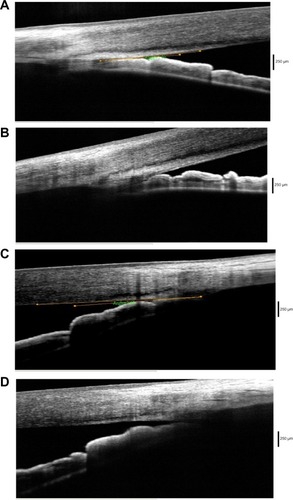 Figure 1 Angles open after laser iridoplasty at treated area.