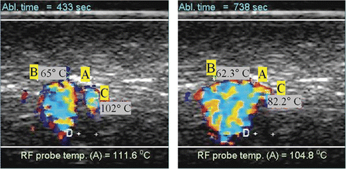 Figure 3. Example of observed colour Doppler ultrasound signals (DUS) superimposed on B-mode images. The two images shown were taken at different times during an RFA ablation experiment using the needle probe. The letter A indicates the location of the RFA probe while letters B and C denote thermocouple locations (2 mm apart as measured with the scanner).