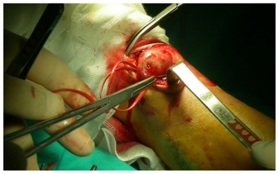 Figure 3 The bleeding was controlled from the proximal and distal aneurysm sides.