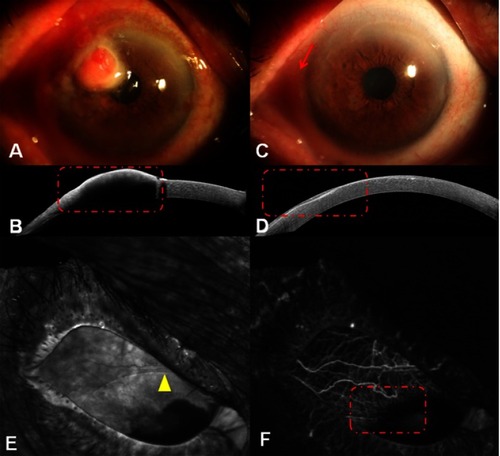 Figure 3 Anterior segment images of Case 2 (right eye). (A) A large nodular leukoplakic tumor involving the cornea and limbus. (B) AS-OCT demonstrated an abrupt transition between unremarkable and thickened hyper-reflective epithelia. However, in these large lesions, a shadow from the hyper-reflective epithelium sometimes obscured the plane of cleavage (red dots). (C) The tumor completely disappeared after treatment, with tiny palpebral fissures remaining (red arrow). (D) The neoplasm was completely replaced by a normal epithelium after treatment, as observed via AS-OCT (red dots). (E) No leakage was found through FA after treatment, and the patient wore a contact lens during angiography (yellow triangle). (F) ICGA anterior segment images revealed that both intratumoral vessels and conjunctival feeding vessels disappeared after treatment (red dots).Abbreviations: AS-OCT, anterior segment optical coherence tomography; FA, fluorescein angiography; ICGA, conjunctival indocyanine green angiography.
