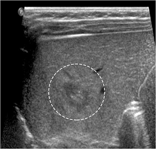 Figure 3 A two-dimensional grayscale diagram before treatment revealed an approximately 1.3×0.9×1.5 cm hemangiomatoid solid mass in the patient’s right liver. The white circle indicates the location of the hepatic hemangioma.