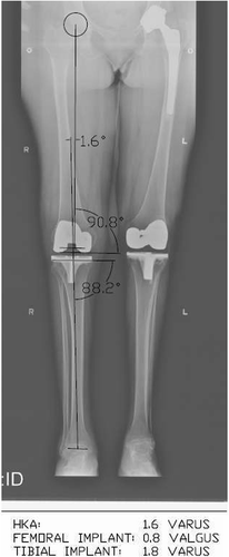 Figure 1. Long standing X-ray showing the different angles that were measured manually. These were the HKA angle; the coronal angle of the femoral implant (measured as the angle of intersection of the femoral mechanical axis with the joint surface plane of the femoral implant); and the coronal angle of the tibial implant (measured as the angle of intersection of the tibial mechanical axis with the joint surface plane of the tibial implant).