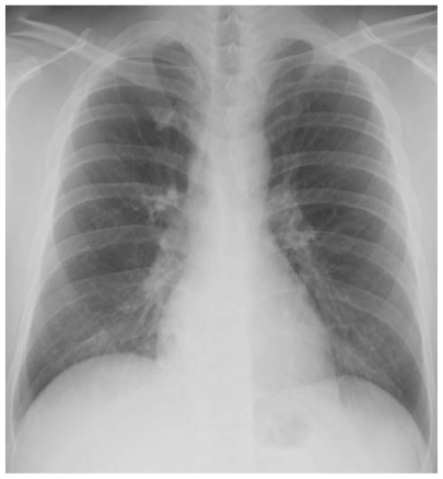 Figure 1 A chest radiograph revealed infiltration in the lower lobe of right lung.