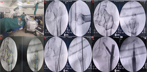 Figure 1 (a) Placement of robot navigation system; (b) The C-arm X-ray machine showed satisfactory fracture reduction; (c) 10 position points were shown in the X-ray image of Hip joint; (d) Planed the ideal guide pin channel; (e) The robot navigation system placed the guide pin along the planned channel; (f) The C-arm X-ray machine showed satisfactory fracture reduction and good internal fixation position.