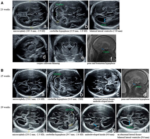 Figure 1. Radiographic findings for the two fetuses. An ultrasound image showing microcephaly (187.4 mm; -2.9 SD) (a), cerebellar hypoplasia (22.9 mm; –1.0 SD) (b), dilated bilateral lateral ventricles (>10 mm) (c), and corpus callosum thinning (d, e). A precise midsagittal T2-weighted brain MRI sequence determined that the diameter of the pontine was 5.69 mm (reference: 8.48 mm) at 24 weeks of pregnancy, implying pons and brainstem hypoplasia in the first fetus (f). B Ultrasound images showing the second fetus at 25 weeks of gestation with recurrent microcephalia (216.2 mm; -2.4 SD) (a), cerebellar hypoplasia (24.9 mm; -2SD) (b), an abnormal lateral fissure and an underdeveloped insula (6.5 mm) (c). The precise midsagittal T2-weighted brain MRI sequence showed that the diameter of the pontine was 7.14 mm (reference: 8.96 mm) at 26 weeks of pregnancy, and the shape was not full, indicating pons and brainstem hypoplasia (d). Ultrasonic scans at 29 weeks showed persistent microcephaly (255.2 mm; –2.3 SD) (e), cerebellar hypoplasia (29.7 mm; -2.6 SD) (f), an underdeveloped insula (9.0 mm) (g), an abnormal lateral fissure and bilateral lateral ventricles with a diameter of 9.6 mm (h).
