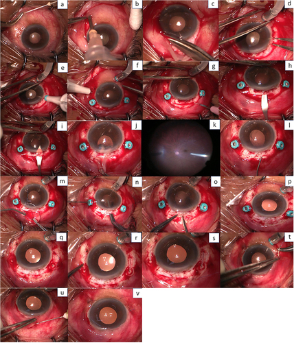Figure 2 Complete surgical procedures. (a) Lidocaine subconjunctival injection. (b) Sub-tenon block. (c) 270-degree conjunctival peritomy. (d) An infusion cannula is inserted at infero-temporal. (e) 2 scleral markings at the temporal side adjacent to the 3 o’clock position. (f) 2 scleral markings at the nasal side adjacent to 9 o’clock position, 2 mm from the limbus and 4 mm apart between each marking (2 mm superior and 2 mm inferior to 3 and 9 o’clock points). (g) 6 mm scleral tunnel incision created at superior sclera using slit knife. (h) The lamellar sclerocorneal tunnel was made using crescent knife. (i) Internal corneal incision connecting the tunnel and anterior chamber. (j) IOL was evacuated. (k) Complete vitrectomy and vitreous shaving are performed. (l) Ophthalmic viscoelastic device (OVD) was injected. (m) Polypropylene 8-0 sutures inserted into each lens eyelet, IOL is positioned in a correct intraocular position at the entrance of the tunnel. (n) Nasal side thread is pulled and externalized from each sclerotomy using micro-forceps. (o) Temporal side thread is also pulled and externalized and IOL is then inserted. (p) Stabilize the IOL. (q) The suture is tightened evenly until the IOL is central. (r) The knots are rotated and internalized through the sclerotomy sites. (s) The scleral tunnel is sutured with 8-0 vicryl. (t) Conjunctiva is sutured using 8-0 426443 vicryl. (u) Antibiotic subconjunctival injection. (v) Surgery procedures are done.