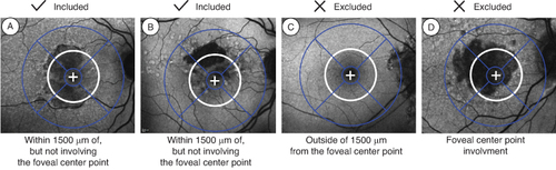 Figure 2. GATHER clinical program baseline lesion inclusion and exclusion criteria: (A) and (B) examples of lesions within 1500 microns of, but not involving, the foveal center point. (C) Outside of 1500 microns from the foveal center point. (D) Involving the foveal centerpoint.