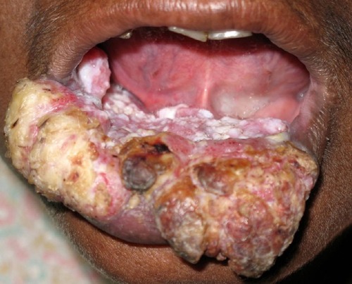 Figure 8 Oral squamous cell carcinoma in a patient with oral submucous fibrosis.