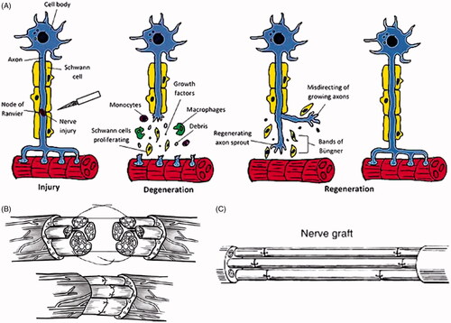 Figure 1. (A) Schematic representation of the Wallerian degeneration [Citation9]. (B) Schematic representation of end-to-end surgical reconnection of the injured nerve ends [Citation10]. (C) Schematic representation of the autologous nerve grafting [Citation11].