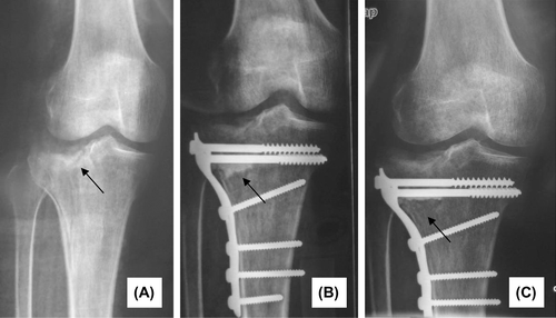Figure 3. (A) Preoperative: fracture of left tibial plateau. (B) 3 months postoperatively: The delimitation between new bone tissue and normal bone tissue were clear. (C) 26 months postoperatively: most of the material was degraded and new bone tissue was formatted.