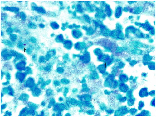 Figure 2. Histological image with hematoxylin-eosin coloration demonstrating the chronic inflammatory process, with bacillus (black arrows).