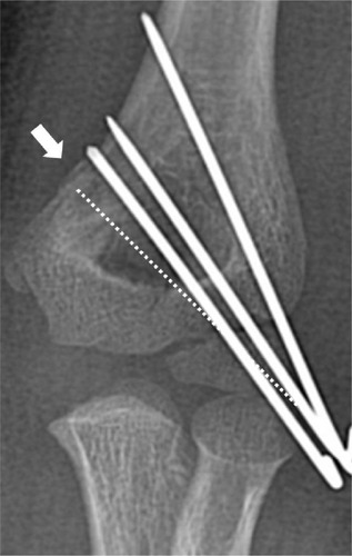 Figure 3 Due to medial comminution (white arrow), medial pin is more vertical than ideal position (dotted line).
