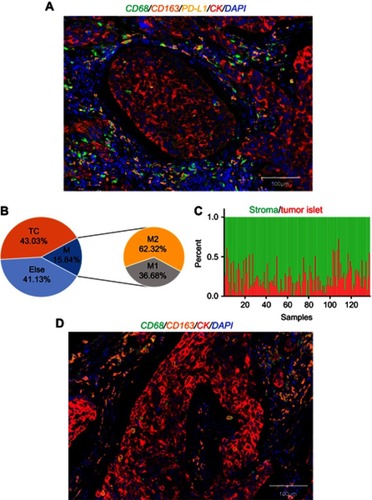 Figure 1 The macrophage landscape in the microenvironment of NSCLC. (A) A representative image using multiple quantitative fluorescence staining. Blue, DAPI; red, CK; green, CD68; orange, CD163; yellow, PD-L1. Scale bars =100 μm. (B) Quantity of cell subpopulations normalized to the total cell numbers in TIME. (C) Proportion of macrophage distribution in stroma (green) and tumor islets (red) of 137 patients in NSCLC microenvironment. Each column represents a patient. (D) A representative image of macrophages distributed in the tumor microenvironment. Blue, DAPI; red, CK; green, CD68; orange, CD163. Scale bars =100μm.Abbreviations: TC, tumor cells; M, total macrophages; M1, M1 macrophages; M2, M2 macrophages; NSCLC, non-small-cell lung cancer; TIME, tumor immune microenvironment. 