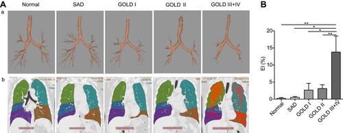 Figure 2 The three-dimensional reconstruction of lung by ISP 9.0. (A) The total bronchi count generated was signiﬁcantly reduced with severity of disease. (B) EI generated in the late COPD was worse than in the early COPD.