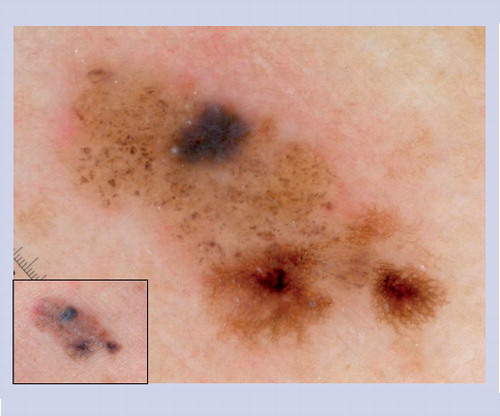 Figure 2. Congenital melanocytic nevus with a disorganized, multicomponent pattern.In the presence of a focal network, irregular globules and an irregular blotch, melanoma should be definitively ruled out.