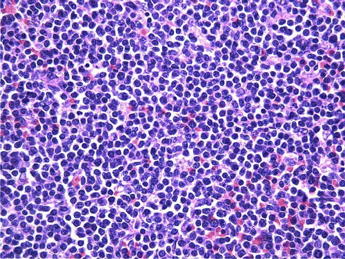 Figure 2.  High power H and E stained section of spleen demonstrating the slight nuclear irregularities of the small lymphocytes. (original magnification×400).