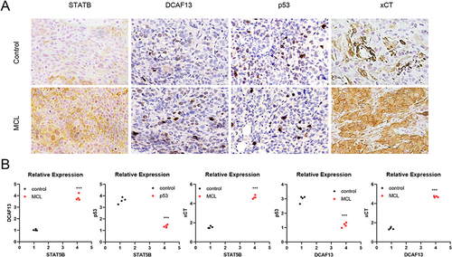 Figure 2 Expression characteristics and correlation of STAT5B, DCAF13, xCT and GPX4 in MCL. (A) Immunohistochemical staining to detect the expression of STAT5B, DCAF13, xCT and GPX4 in MCL lymph node tissues and healthy lymph node tissues. (B) Pearson was applied to test the association of STAT5B with DCAF13, xCT and GPX4, and the association of DCAF13 with xCT and GPX4. The relative expression level with the control group as 1. ***P < 0.001 vs control.