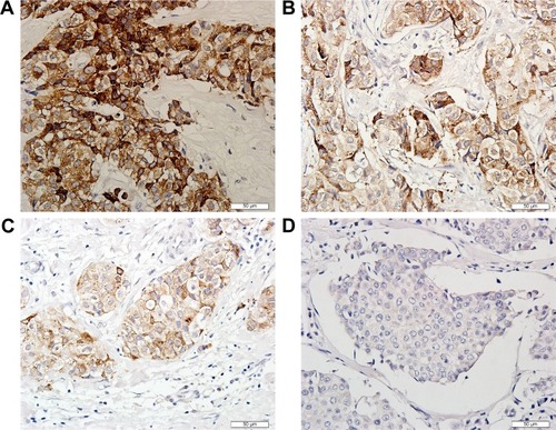 Figure 2 Immunohistochemistry images of IRAK1 expression in matched breast tumor tissues pre- and post-neoadjuvant chemotherapy (NCT).Notes: (A–D) Representative staining images of IRAK1 in matched breast tumor tissues pre- and post-NCT. (A) Strongly stained. (B) Moderately stained. (C) Moderately stained. (D) Negatively stained. Magnification ×400.