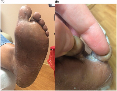 Figure 2. (A) Scaly plaques on the plantar surfaces of both feet. (B) Interdigital maceration due to tinea pedis.