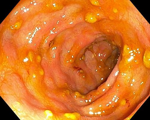 Figure 9 Colonoscopy pictures from case no. 4.