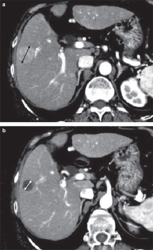 Figure 2. A: CT before TACE: Both criteria (RECIST version 1.1 and mRECIST) measured the longest diameter of the tumor. B: CT after TACE: The tumor had become entirely necrotic. The tumor response was evaluated as CR using mRECIST criteria (i.e. no measurement) and as non-CR using RECIST version 1.1 criteria (i.e. the measurement of the longest diameter of the entire tumor).