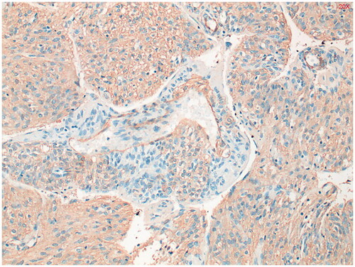 Figure 4. Alfa-smooth muscle actin (alfa-SMA) staining shows diffuse, moderately intense staining throughout the tumor. Positive in 80% of PEComa’s.