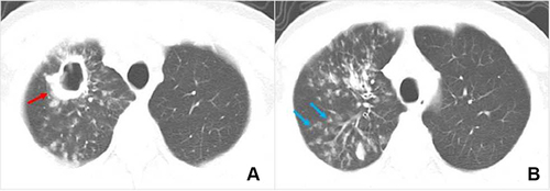 Figure 1 Multidrug-resistant pulmonary tuberculosis in a 32-year-old male patient. (A and B) Axial computed tomography images of the lung window indicate a thick-walled cavity (red arrow), patchy consolidation, and centrilobular micronodules and tree-in-bud sign (blue arrow) in the right upper lobe.