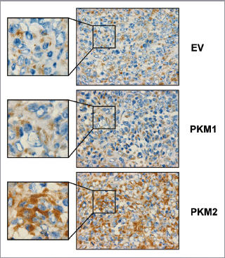 Figure 10 Fibroblasts overexpressing PKM2 induce oxidative mitochondrial activity in breast cancer cells in vivo. To evaluate mitochondrial activity in situ, the activity of Complex IV was detected via COX (Cytochrome C Oxidase) activity staining of frozen sections derived from tumor xenografts. Note that COX activity is increased specifically in the cancer cells of PKM2-tumors. Conversely, PKM1-tumors do not display increased mitochondrial activity. Original magnification, 60×.