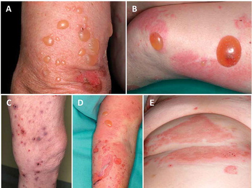 Figure 1. Clinical presentations of bullous pemphigoid. Tense blisters on normal skin (A), tense blisters on erythematous and normal skin (B+D), prurigo-like bullous pemphigoid (C), and urticarial lesions (E).