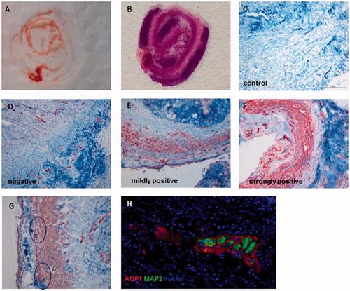 Figure 1. (A) Cryosection and (B) H.E. staining of appendix role. (C–F) Representative images of control, AQP1 negative, AQP1 mildly positive and strongly positive immunohistochemical staining (10× standard microscopic enlargement) (G) Consecutive pictures of tip and base were taken (10× standard microscopic enlargement) and AQP1 positive ganglia were counted (H) Immunofluorescence co-staining revealed different expression patterns for AQP1 and MAP2 (40x standard microscopic enlargement).