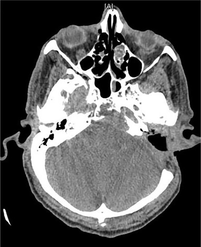 Figure 6 Case 3: Computed tomography brain showing a large infiltrative mass involving the petrous, tympanic, and mastoid parts of the left temporal bone with intracranial extension.