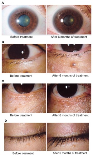 Figure 1 Adverse reactions to bimatoprost around the eyes (A) Iris pigmentation, (B) Increase in vellus hair of the lid, (C) Eyelid pigmentation, (D) Eyelash growth and bristliness.