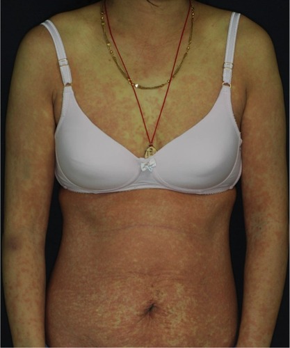 Figure 2 Drug rash with eosinophilia and systemic symptoms after erlotinib treatment for 4 weeks.Notes: A 60-year-old woman with EGFR-mutant metastatic lung adenocarcinoma treated with erlotinib for 4 weeks. She developed generalized infiltrative exanthema on trunk and limbs accompanied by fever, acute liver failure, coagulopathy, and leukocytosis with eosinophilia. Further lymphocyte activation testing confirmed a hypersensitivity reaction to erlotinib.