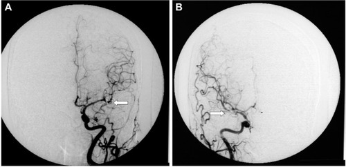 Figure 3 DSA images of the left and right internal carotid arteries after clipping. Both aneurysms from the bilateral middle cerebral artery branches are completely occluded (normal position, indicated by the arrow).