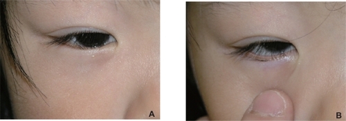 Figure 1 A) A 3-year-old girl. Upright position without downward traction of the skin. The eyelashes are directed vertically and rub on the cornea. The redundant skin only touches the eyelash roots and therefore it seems to have a minimal contributing role in eyelash inversion. B) Upright position with downward traction of the skin. The direction of the eyelashes is not changed significantly, and they are still directed to the globe.