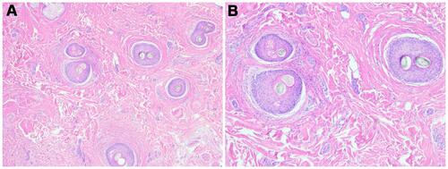 Figure 10 Hematoxylin and eosin stain of the vertex zone of Patient 3 at the time of stopping oral minoxidil The transverse section magnification X2 (A) and magnification X4 (B) show all follicles in catagen phase with a mild perifollicular lymphocytic infiltrate. One follicle shows premature desquamation of the inner root sheath. Scarring with diminished adipocytes is noted.